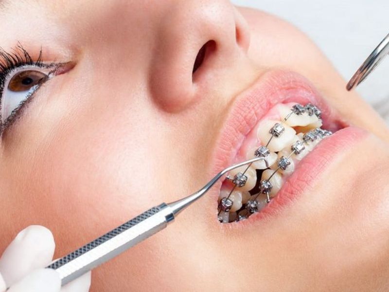 Kỹ thuật niềng răng không đúng là một trong những nguyên nhân gây lệch hàm