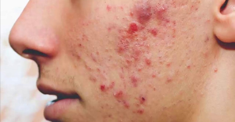 Mụn đỏ thường gặp ở độ tuổi dậy thì