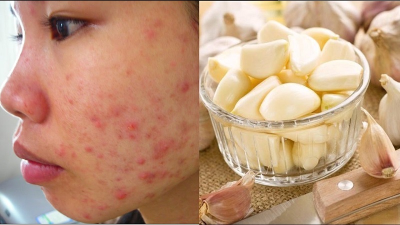 Trị mụn đỏ bằng dịch chiết của tỏi khá hiệu quả