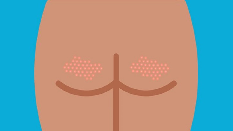 Có nhiều nguyên nhân dẫn đến tình trạng mụn trên mông