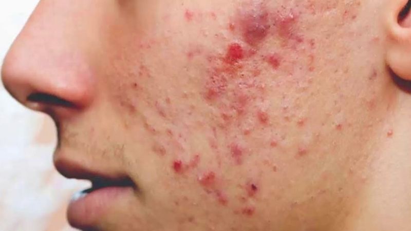 Biểu hiện khi bị mụn sưng đỏ không nhân