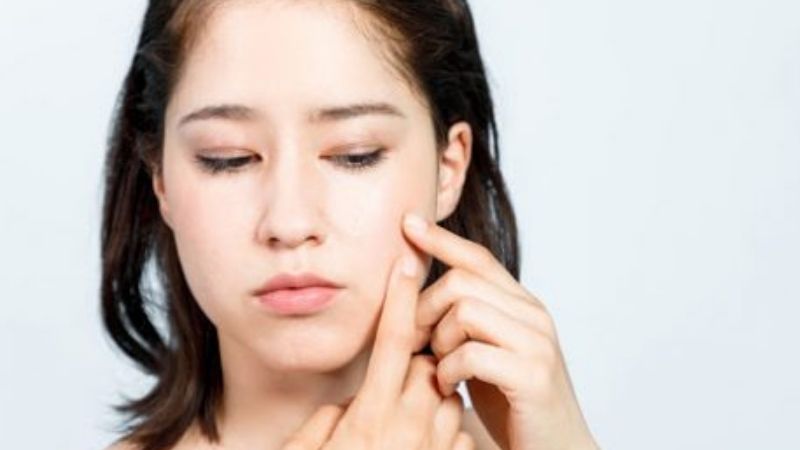 Dùng tay nặn mụn dễ khiến các nốt mụn sưng nặng hơn