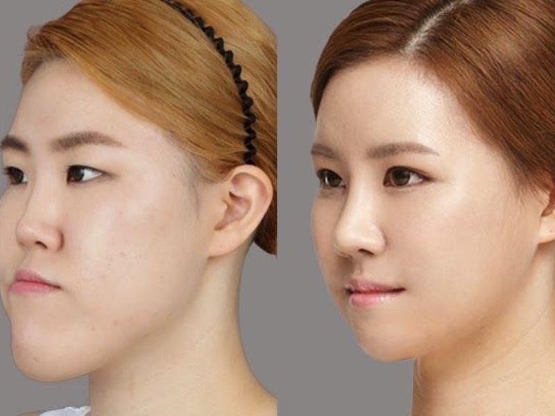 Phẫu thuật chỉnh hàm cũng là một giải pháp để khắc phục