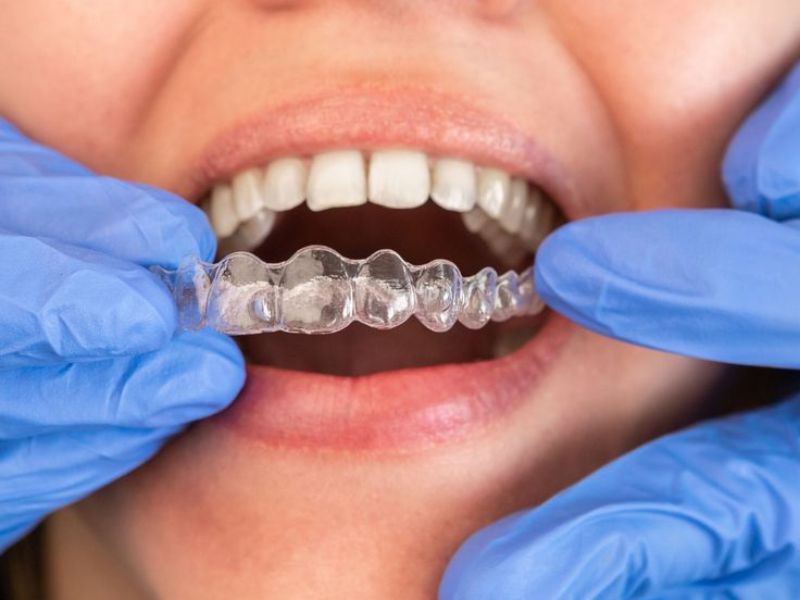 Để quá trình niềng răng được hiệu quả hơn bạn có thể kết hợp đeo niềng duy trì