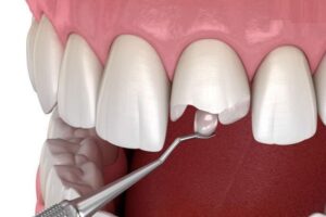 Khi răng cửa bị mẻ với diện tích nhỏ, không ảnh hưởng nhiều tới mô răng, có thể áp dụng phương pháp trám răng