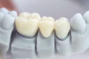 Uống nước đá sau bọc sứ có gây buốt và nứt không? Điều bạn nên biết