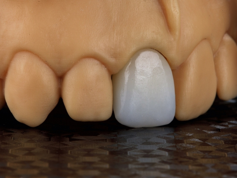 Những người có răng nhiễm màu kháng sinh, xỉn màu hoặc ố vàng nặng nề nên bọc răng sứ 1 chiếc để cải thiện