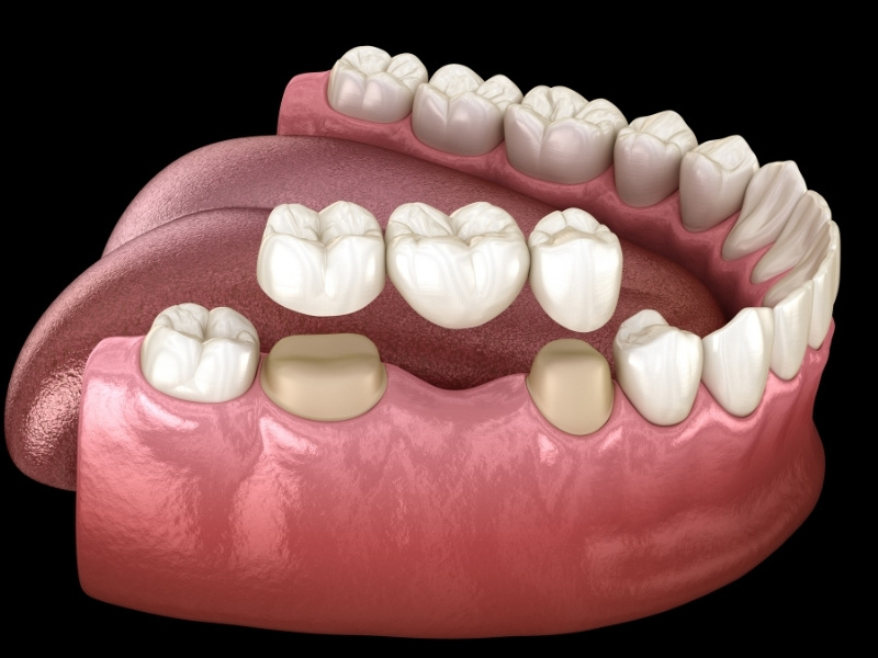 Răng sứ kim loại được đánh giá tốt về khả năng chịu lực, chi phí phải chăng nhưng có thể bị oxi hoá trong môi trường khoang miệng