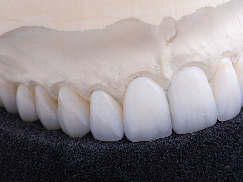 Răng toàn sứ có độ bền tối ưu, thẩm mỹ cao, tuổi thọ lên tới 15 - 20 năm hoặc lâu hơn nếu biết cách chăm sóc