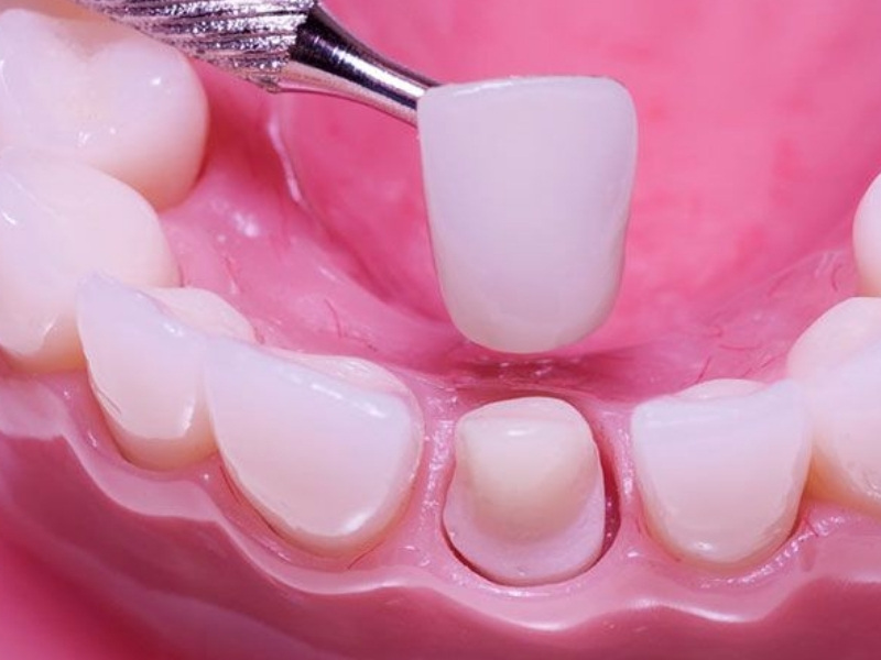 Quy trình bọc răng sứ 1 chiếc đòi hỏi sự cẩn thận, chuyên nghiệp của bác sĩ nha khoa