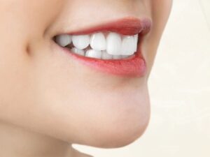 Bọc sứ có được bảo hành không? Hướng dẫn đầy đủ về chế độ bảo hành