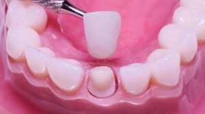 Bọc sứ có chụp MRI được không? Hướng dẫn an toàn