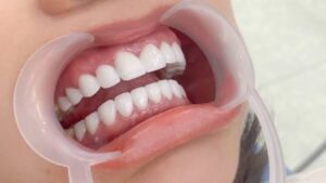 Bọc răng sứ bị lệch khớp cắn: Nguyên nhân và cách sửa