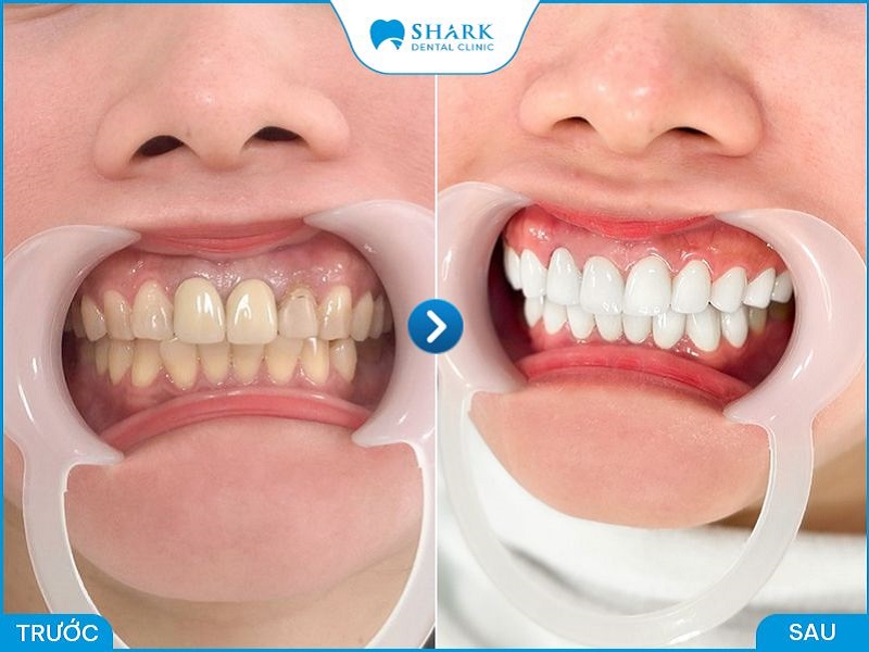 Kết quả bọc răng sứ tại nha khoa Shark minh chứng cho chất lượng, dịch vụ tốt