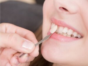 Bọc răng sứ không mài được áp dụng trong một số trường hợp nhất định