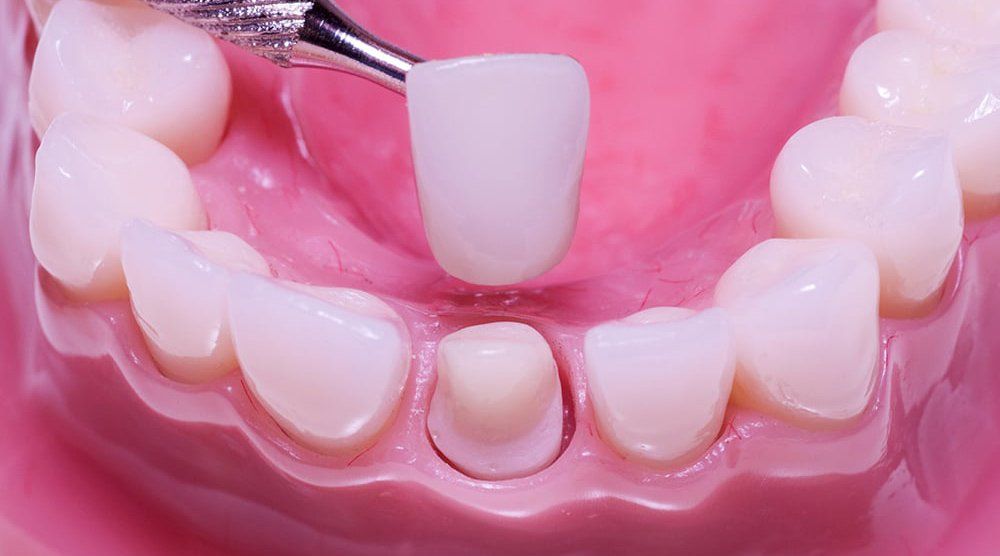Bọc sứ có chụp MRI được không? Hướng dẫn an toàn