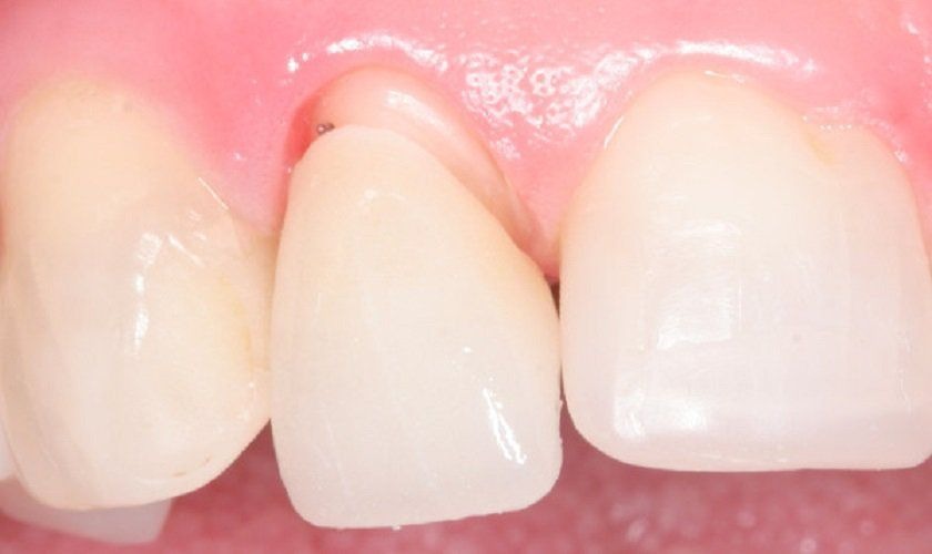 Bọc sứ bị hở nướu: Nguyên nhân, dấu hiệu và cách khắc phục