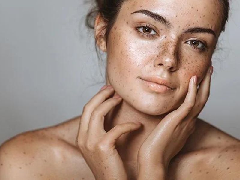 Mách bạn cách chăm sóc da mặt bị nám tại nhà, cho da sáng, khỏe