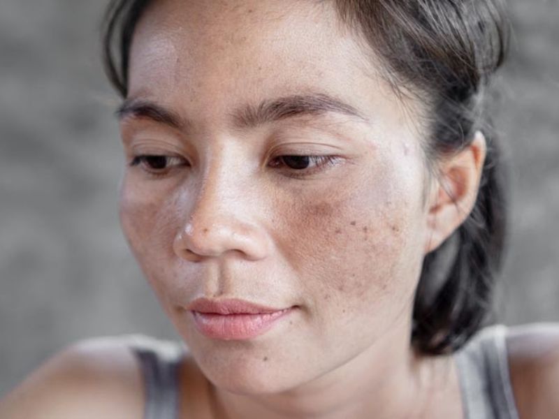 Làn da bị nám tối sạm đánh mất đi vẻ rạng ngời, tươi tắn trên khuôn mặt, rất mất thẩm mỹ.