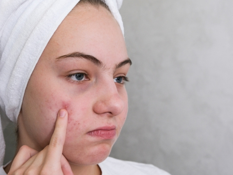 Mụn xuất hiện nhiều ở độ tuổi dậy thì nhưng đến năm 30 tuổi, tình trạng mụn có thể tái phát