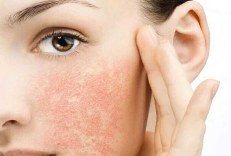 Tình trạng da bị kích ứng sau khi lăn kim.