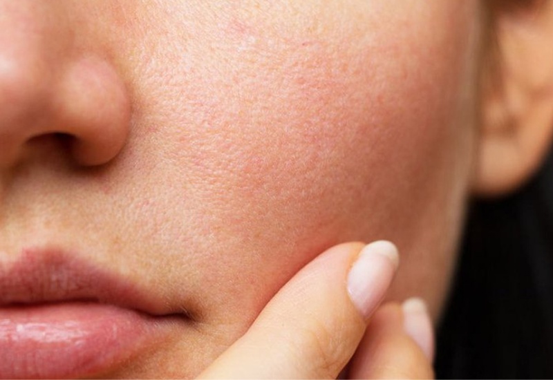 Da sau khi Peel trong ngày đầu tiên thường bị ửng đỏ và nhạy cảm