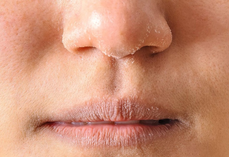 Trong giai đoạn từ 1 đến 3 ngày sau Peel, da sẽ trải qua giai đoạn khô và sạm màu do quá trình bong da