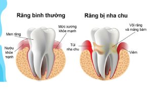 Lấy vôi răng giúp ngăn ngừa bệnh nha chu