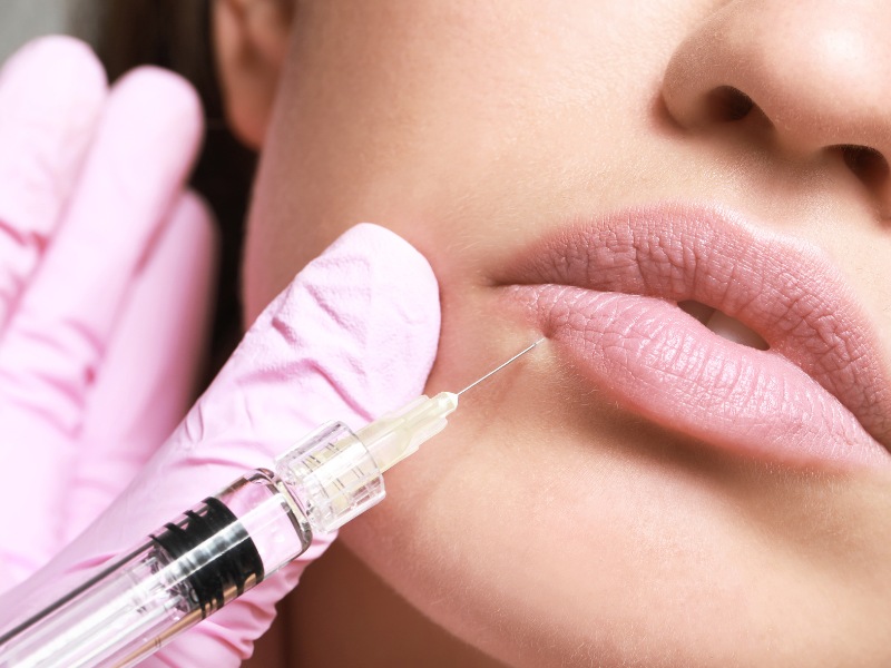 Tiêm filler môi là sự lựa chọn tối ưu, giúp bạn hiện thực hóa việc sở hữu đôi môi căng mọng