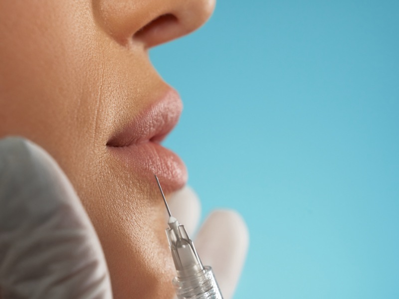 Thời gian hồi phục vết thương sau khi tiêm filler môi khá nhanh