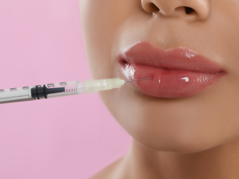 Theo các chuyên gia, môi dày vẫn có thể thực hiện tiêm filler