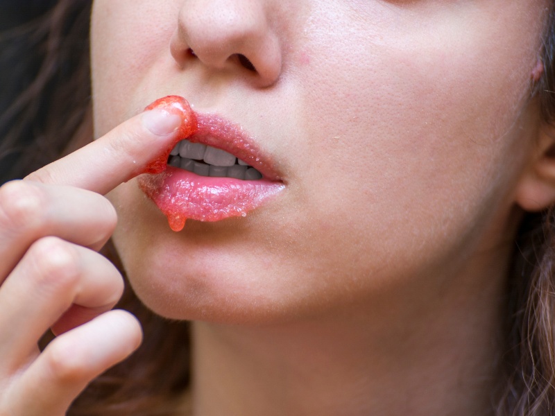 Dị ứng, nhiễm trùng là biến chứng nguy hiểm khi tiêm filler môi