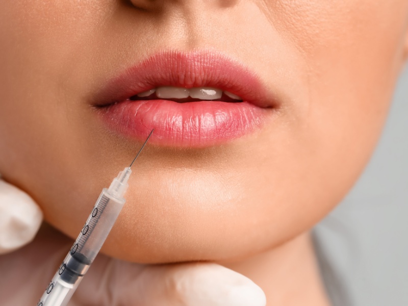 Tiêm filler môi giúp tạo hình dáng môi như ý