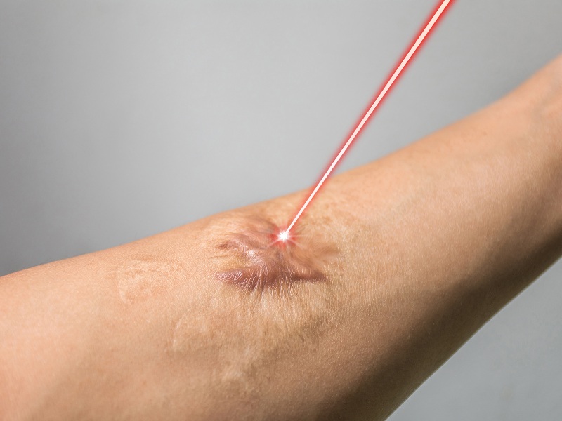 Bạn nên dành thời gian để tìm hiểu về địa chỉ trị sẹo uy tín ở tại Nha Trang