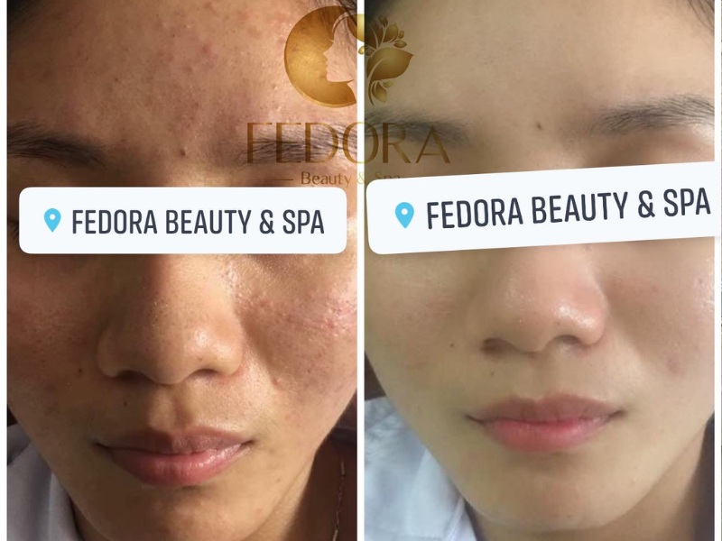 Fedora Beauty & Spa là địa chỉ trị sẹo nổi tiếng tại Nha Trang được nhiều chị em yêu thích