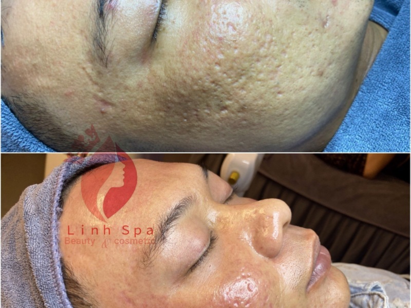 Dịch vụ trị sẹo ứng dụng công nghệ cao, chi phí phải chăng tại Linh Spa