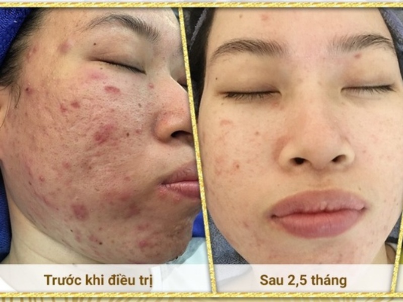 Đẹp Spa & Clinic là cơ sở trị sẹo có tiếng và được nhiều người yêu thích tại Nha Trang