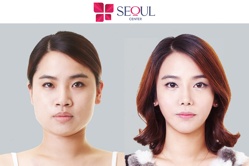 Ca tạo mặt V-Line thành công tại Seoul Center với chi phí hợp lý
