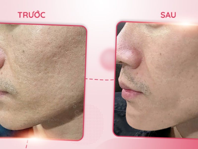 Trị sẹo tại Thẩm mỹ viện SeoulSpa.Vn cho hiệu quả bất ngờ