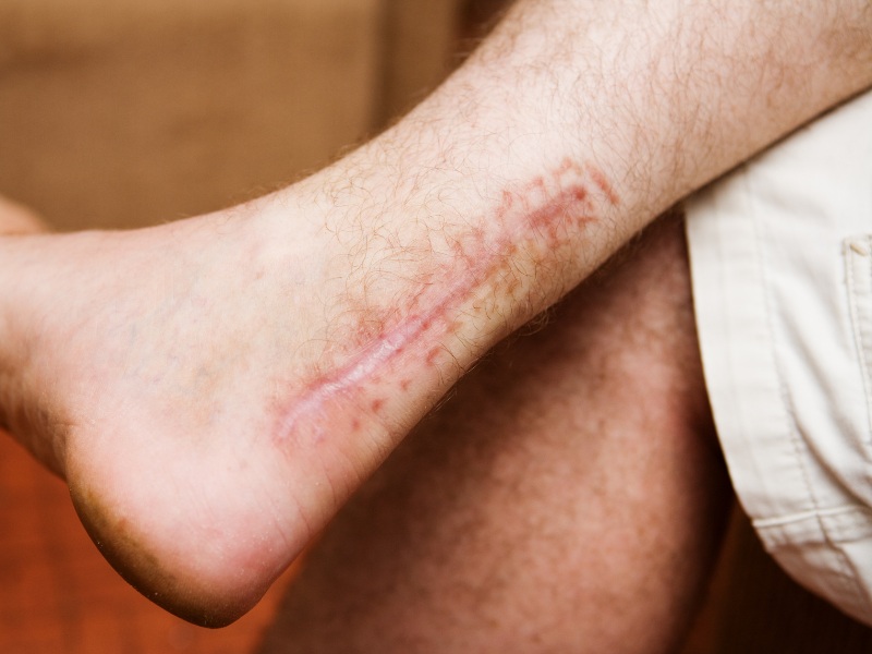 Bạn nên tham khảo và lựa chọn địa chỉ trị sẹo phì đại uy tín, đảm bảo chất lượng