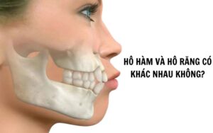 Hô hàm và hô răng có khác nhau không? Cải thiện như thế nào?