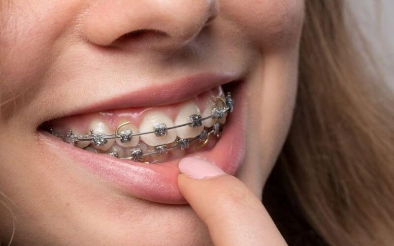 Niềng răng là phương pháp điều trị răng hô tối ưu nhất, được nhiều người lựa chọn