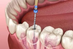 Răng lấy tủy bị vỡ: Cách xử lý theo mức độ và chăm sóc