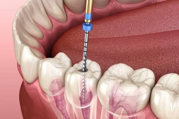 Răng lấy tủy bị vỡ: Cách xử lý theo mức độ và chăm sóc