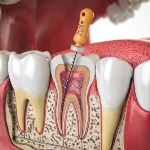 Khi nào cần uống kháng sinh khi điều trị tủy răng? Lưu ý quan trọng