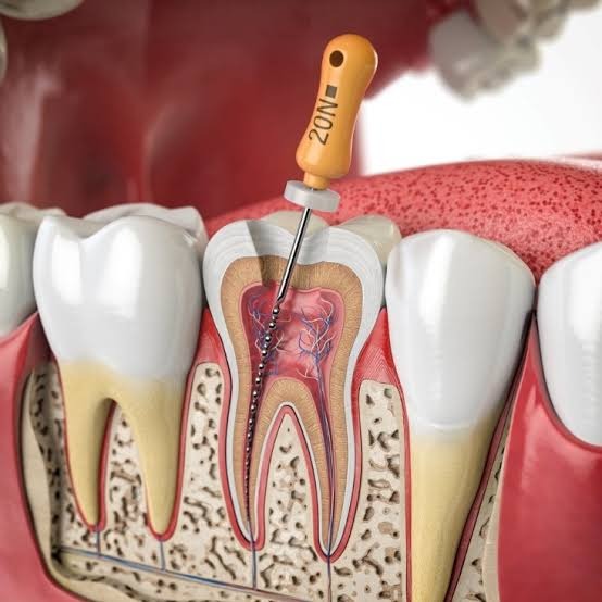 Khi nào cần uống kháng sinh khi điều trị tủy răng? Lưu ý quan trọng