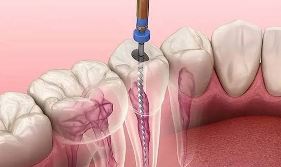 Nuốt phải thuốc diệt tủy nguy hiểm thế nào? Hướng dẫn cách xử lý