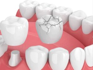 Bọc sứ có bị mẻ vỡ không? Nguyên nhân và cách khắc phục