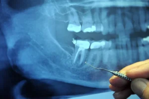 root canal brittle tooth