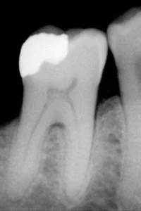 amalgam filling safety